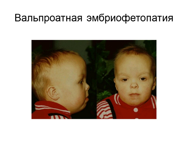 Вальпроатная эмбриофетопатия